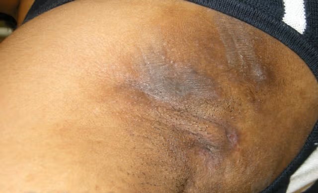 hidradenitis photo